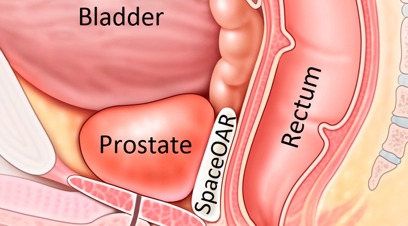 PROSTATE SOLUTION